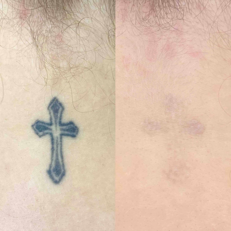 alma laser détatouage avant-après
