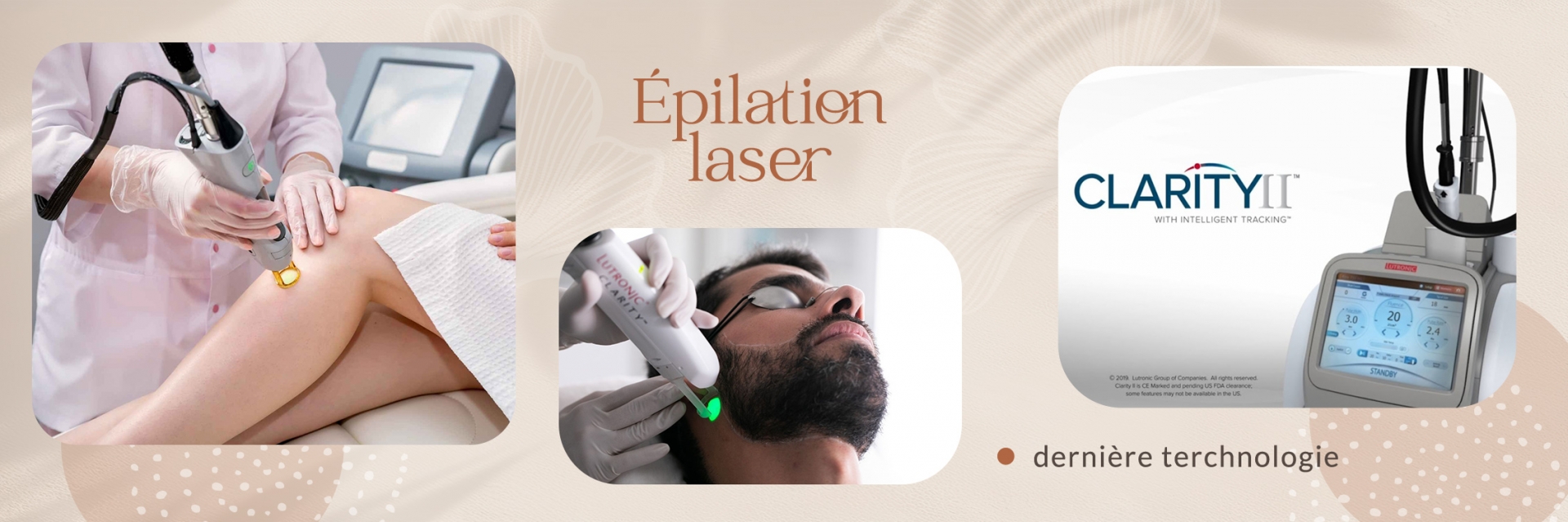 Laser épilation