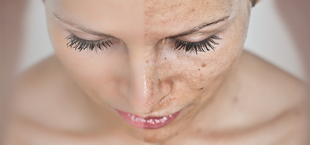 hyperpigmentation