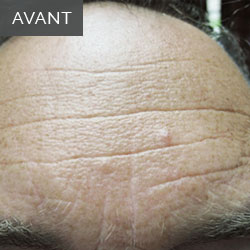 InnoPen homme: Avant