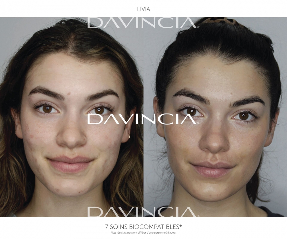 soin acné davincia avant-après