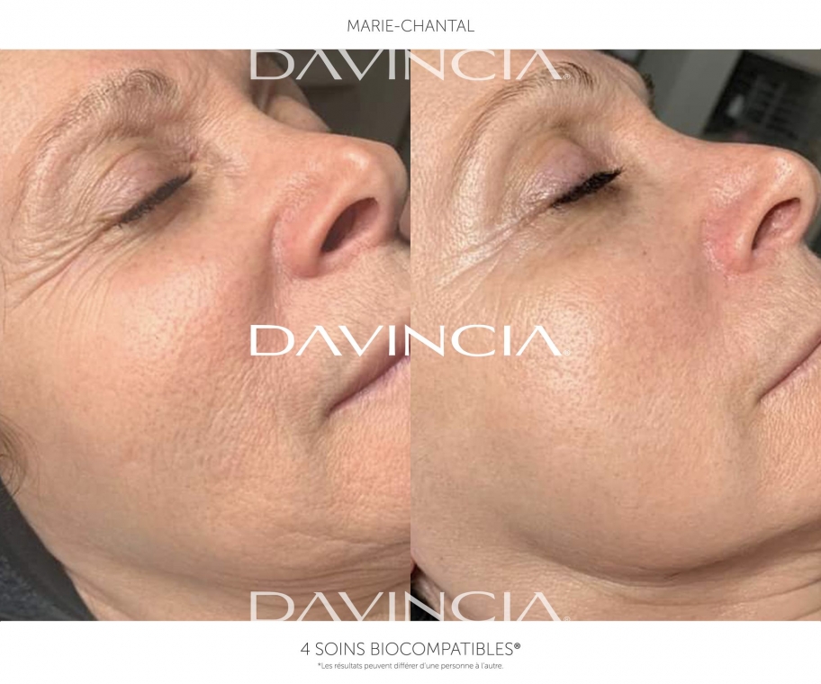 Peeling Davincia : Avant-après 4 soin