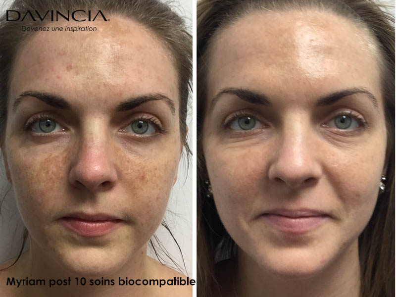 Peeling Davincia avant-apres 10 soins