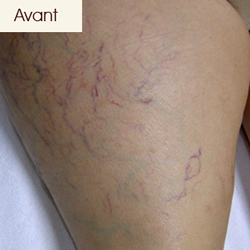 Varices, Varicosités: Avant-après